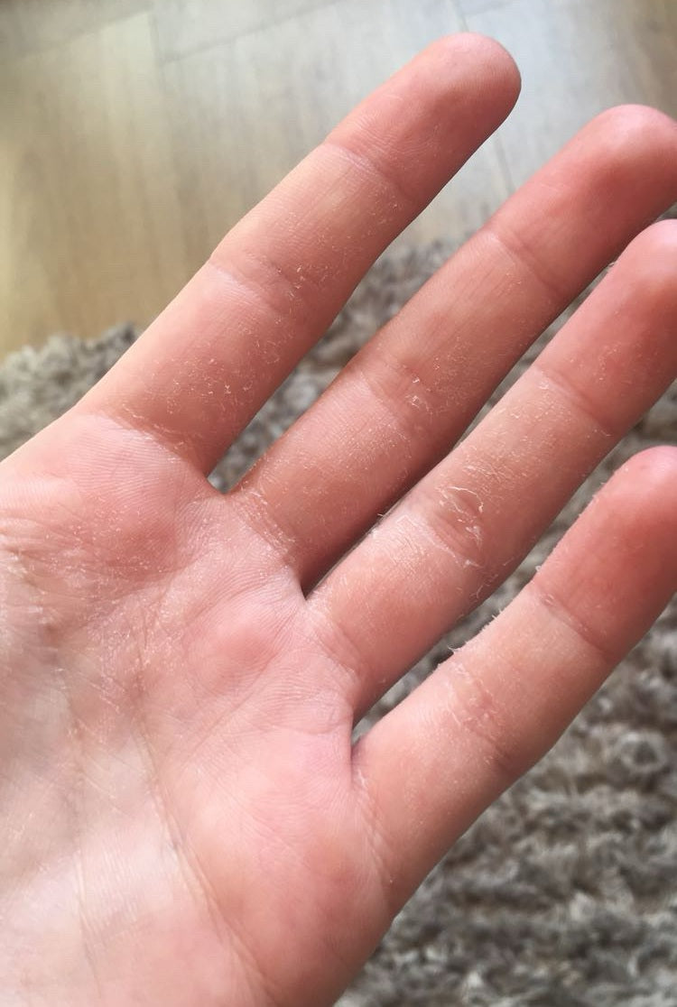 Hudsalva vit E- Salbe für trockene Haut — vorher