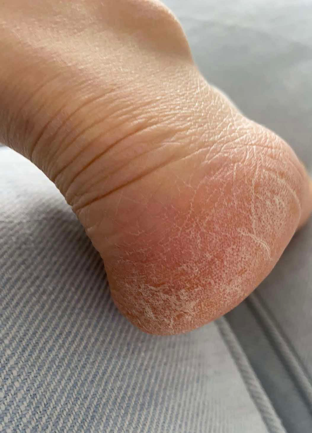 Hudsalva vit E- Salbe für trockene Haut — vorher